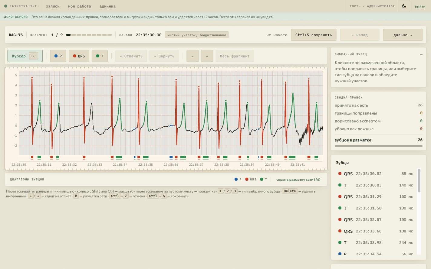 Редактор разметки ЭКГ: кривая с зубцами P, QRS и T, панель инструментов и сводка правок